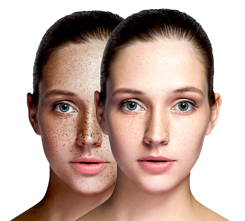 Hydrafacial Treatment